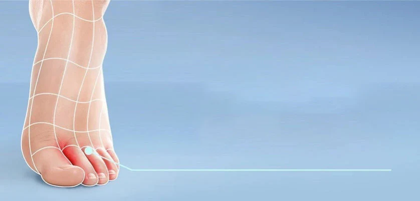 Get rid of Athlete’s foot: Causes and treatment