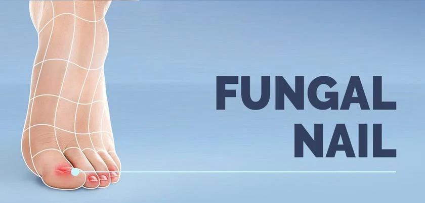Understand and Manage: Fungal Nail